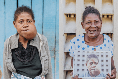 After 10 Years Of Suffering Under A Growing Tumour, Hope And Healing Begins In An Instant 